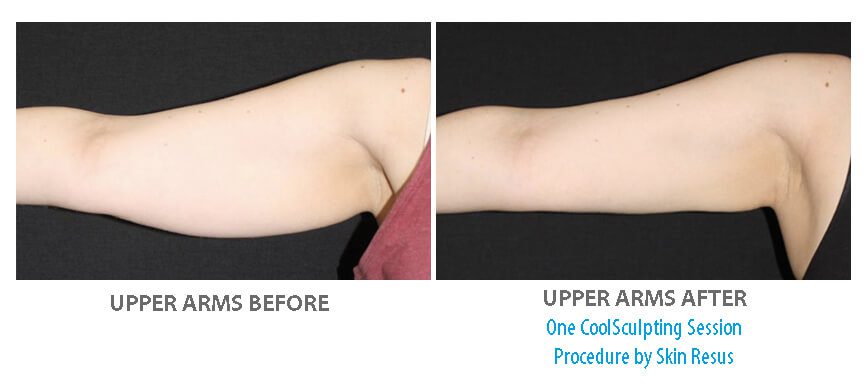 Upper Arms CoolSculpting results
