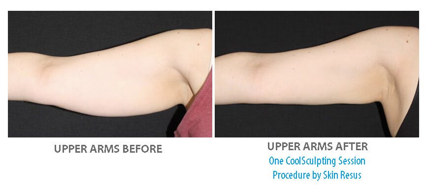 Coolsculpting for the Arms  Contouring for Flabby Arms