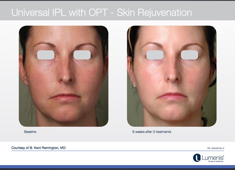 IPL Skin rejuvenation treatment result
