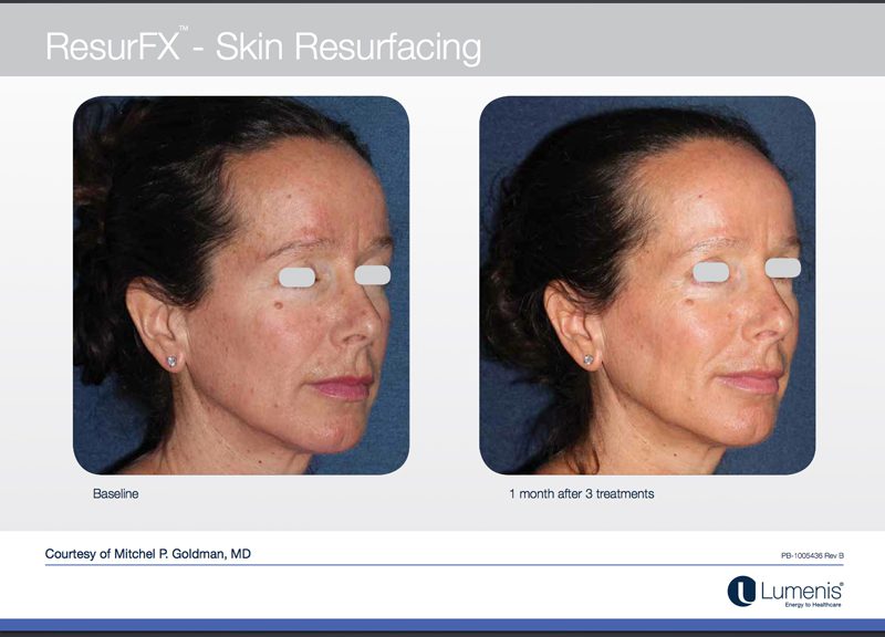 Before and after Skin resurfacing