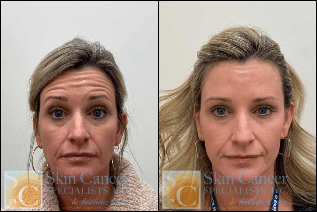 How Much Does Botox Cost?- Skin Cancer Specialists P.c. in Bassetts thumbnail